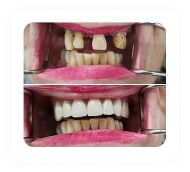 single visit complete teeth makeover smile gallery