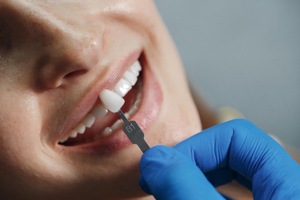 implant crown dental @ niddrie