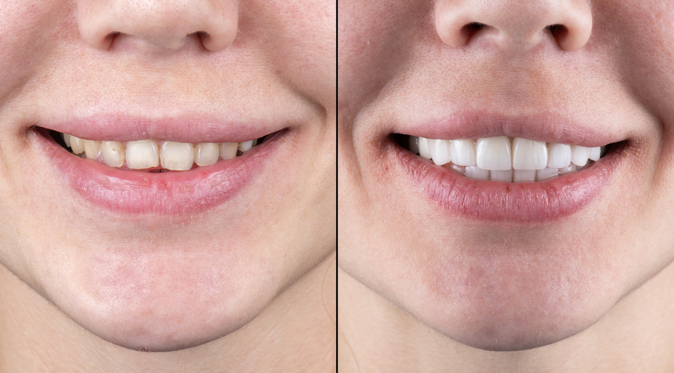 natural looking veneers before after