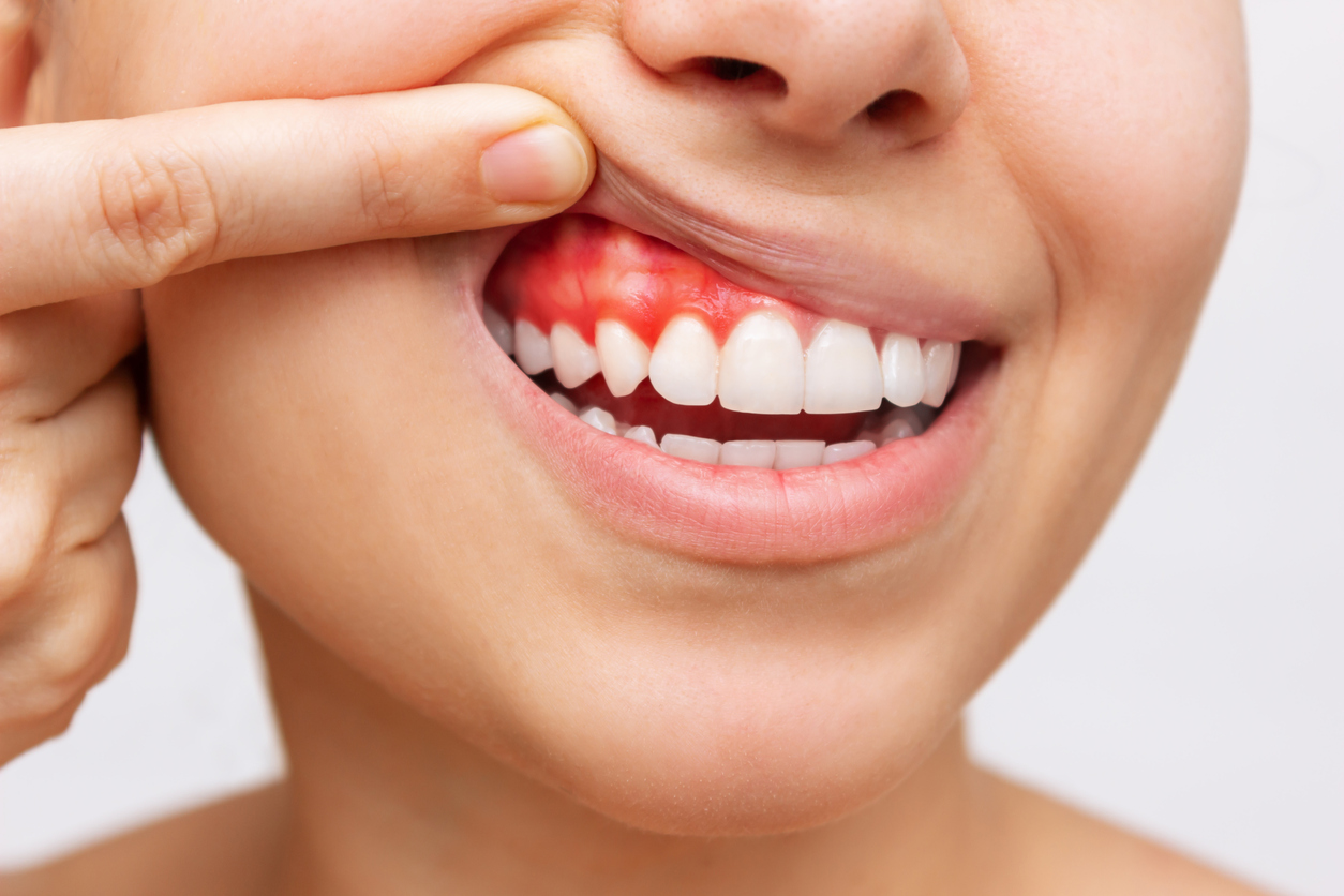 Gum Disease: Early Warning Signs & How to Treat It