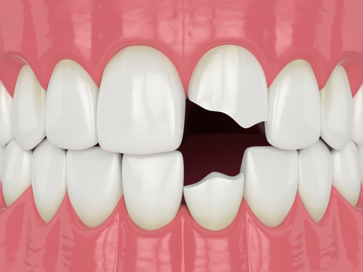 Knocked Out Tooth? Here’s What to do Before you See the Dentist